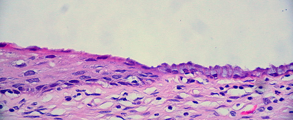 Pink and purple stained cells at the normal cervical tissue junction.